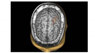 TMS Mapping Ergebnis