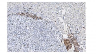 Immunzellinfiltration des Nierenzellkarzinoms 