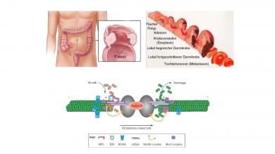 DIAPH2 als potentielles Tumorsuppressor-Protein in der Entwicklung und Metastasierung des Kolonkarzinoms. 