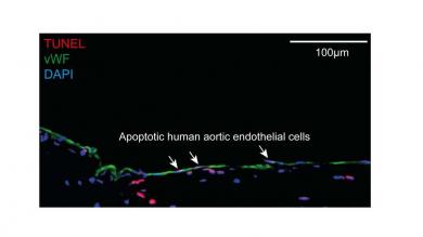 Apoptotische humane Endothelzellen in Aorta, nachgewiesen durch Immunfärbung mit von-Willebrand-Faktor (vWF) und TUNEL-Assay in Querschnitten von humanen atherosklerotischen Plaques. Zellkerne wurden mir DAPI gefärbt.