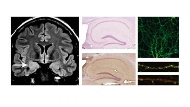 MRT-Befund eines Patienten mit limbischer Enzephalitis und in-vitro Nachweis eines neuen, bisher unbekannten humanen Autoantikörpers.