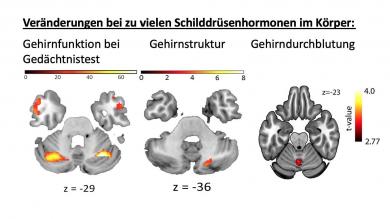 Veränderungen der Gehirnfunktion, Gehirnstruktur und Gehirndurchblutung in ProbandInnen mit induzierter Schilddrüsenüberfunktion