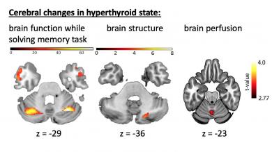 Changes of brain function, brain structure and brain perfusion in subjects with induced hyperthyroidism