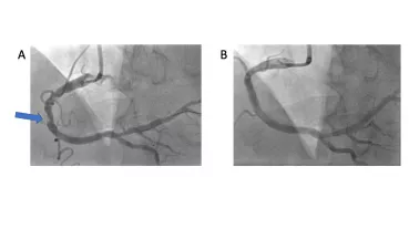 Coronary angiography: Severely calcified coronary stenosis of the Right Coronary Artery before (A) and after (B) coronary Lithoplasty 