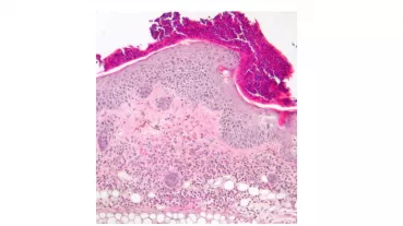 histology of a murine psoriasis