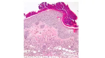 Histologie einer Psoriasis bei der Maus