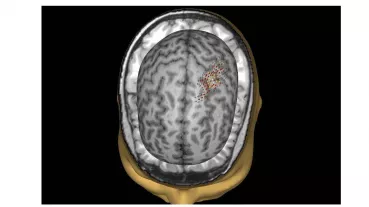 TMS Mapping Ergebnis
