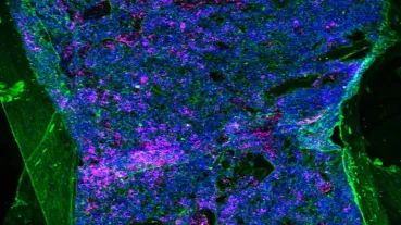 Immunofluorescence image of a bone section of a mouse with chronic myeloid leukaemia. The section was stained with an antibody to fibronectin (green). The nuclei of cells are blue due to staining with DAPI and lineage negative cells are pink. 