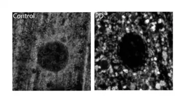 Left image: mitochondrial structure in healthy control flies showing a tubular network. Right image: mitochondrial structure in PD flies lacking a tubular network but instead form accumulations. 
