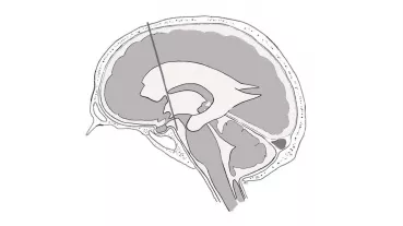 Schematische Darstellung der stereotaktischen Katheter-Ventrikulozisternostomie
