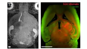 In vivo high field MRI (left) and ultramicroscopy images (right) of the cleared brain shows the extent of tumor cell infiltration of S24 glioma cells (red). The microvasculature is stained with lectin-FITC (green).  
