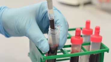 Liquid Biopsy has evolved as a promising approach for noninvasive cancer detection and monitoring. 