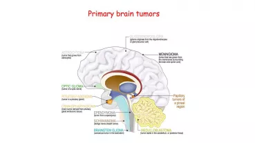 The aim of this research project is to improve brain tumor imaging by combining MRI and PET imaging using novel radiotracers.