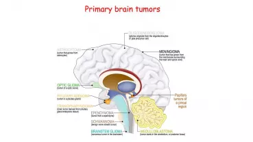 Meningiomas are the most frequent primary tumors of the central nervous system. The typical treatment of nonsurgical resection. 