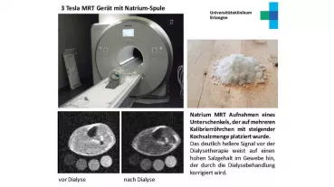 Mithilfe eines neuen Bildgebungsverfahrens auf Basis der Kernspintomografie (Natrium-MRT) kann der Natriumgehalt im Gewebe von Patienten jetzt vor und nach einer Dialysebehandlung direkt gemessen werden. 