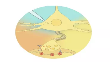Pathogenic antibodies may modulate signaling of neurons. We measure the altered currents to explain symptoms of the patients.