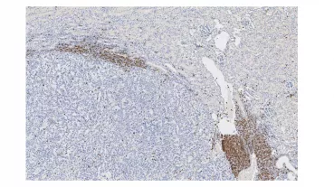 Immune cell infiltration of renal cancer