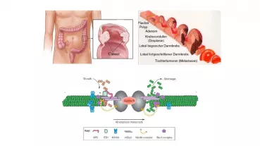 DIAPH2 as a potential tumor suppressor protein in the development and metastasis of colon cancer.