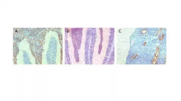 Histochemical AEC staining of Ki-67 (A), nestin (B), CD31(C) of murine medulloblastoma slices.
