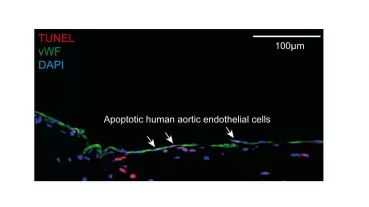 Apoptotic human aortic endothelial cells detected by immunostaining for von willebrand factor (vWF) and TUNEL assay in cross sections of human atherosclerotic plaques. Nuclei were stained with DAPI.