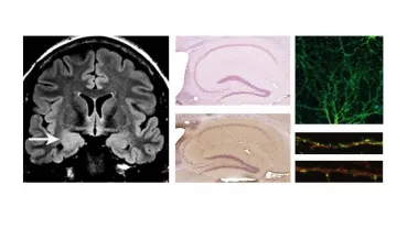 MRI of a patient with limbic encephalitis and in vitro detection of a new, previously unknown human autoantibody.