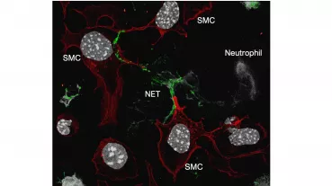 Neutrophil extracellular traps (NET) interact with smooth muscle cells (SMCs). Confocal immunofluorescence image showing smooth muscle cell membrane (phalloidin, red), DNA (DAPI, white) and Histone H4 (green). 