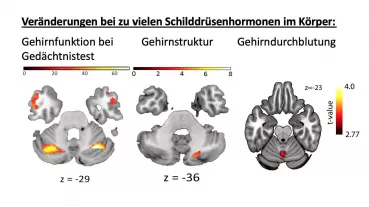 Veränderungen der Gehirnfunktion, Gehirnstruktur und Gehirndurchblutung in ProbandInnen mit induzierter Schilddrüsenüberfunktion