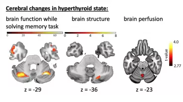 Changes of brain function, brain structure and brain perfusion in subjects with induced hyperthyroidism