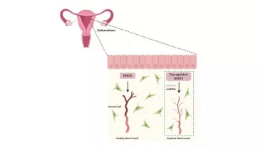 Dysregulated NFAT5 in the endometrium could lead to poor vessel development