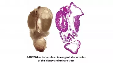 Image: ARHGEF6 mutations lead to congenital anomalies of the kidney and urinary tract
