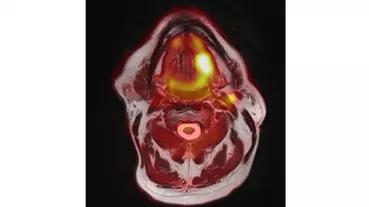 Bild: Tumor der Zunge 