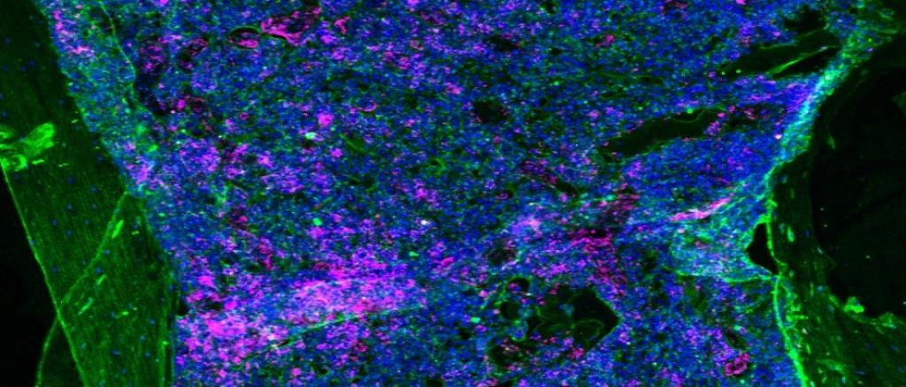Immunofluorescence image of a bone section of a mouse with chronic myeloid leukaemia. The section was stained with an antibody to fibronectin (green). The nuclei of cells are blue due to staining with DAPI and lineage negative cells are pink. 