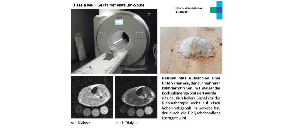 Mithilfe eines neuen Bildgebungsverfahrens auf Basis der Kernspintomografie (Natrium-MRT) kann der Natriumgehalt im Gewebe von Patienten jetzt vor und nach einer Dialysebehandlung direkt gemessen werden. 