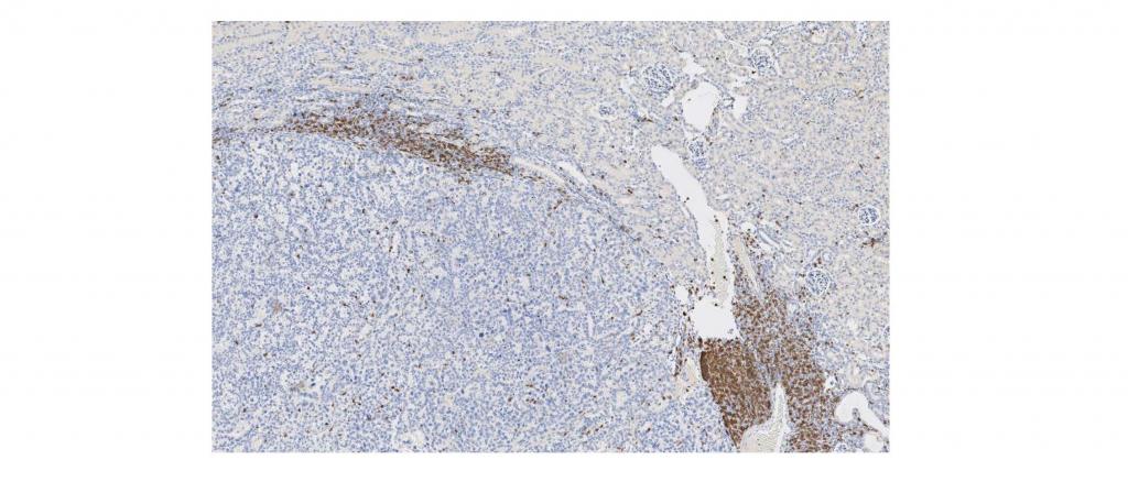 Immune cell infiltration of renal cancer