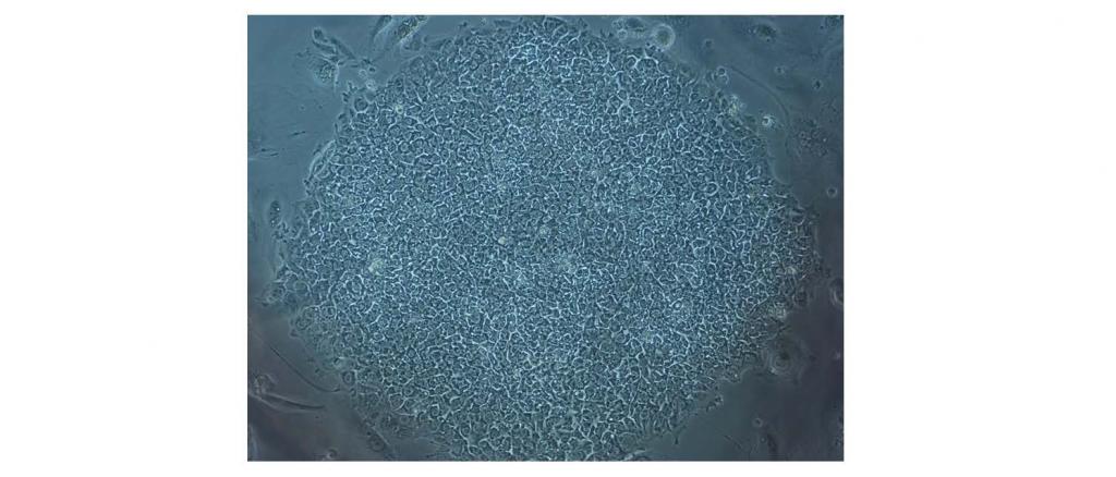 Bright field microscopy image of inducible pluripotent stem cells (iPSCs) generated from blood cells of a severe congenital patient with inherited mutation in the HAX1 gene